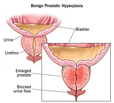 benign prostatic hypertrophy, BPH