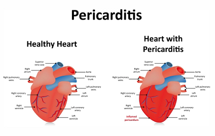 pericarditis , chest pain