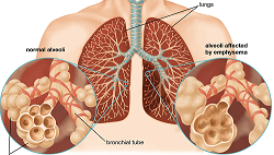 COPD, CHRONIC OBSTRUCTIVE PULMONARY DISEASES