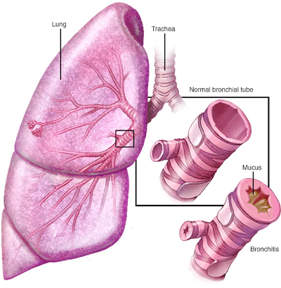 BRONCHITIS, COPD