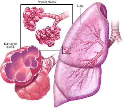 EMPHYSEMA, COPD 