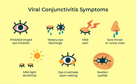 viral conjunctivitis symptoms