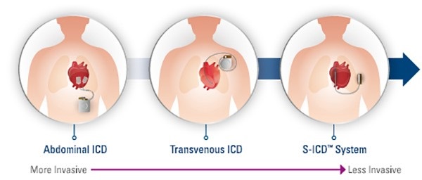 ICDs , types of ICDs