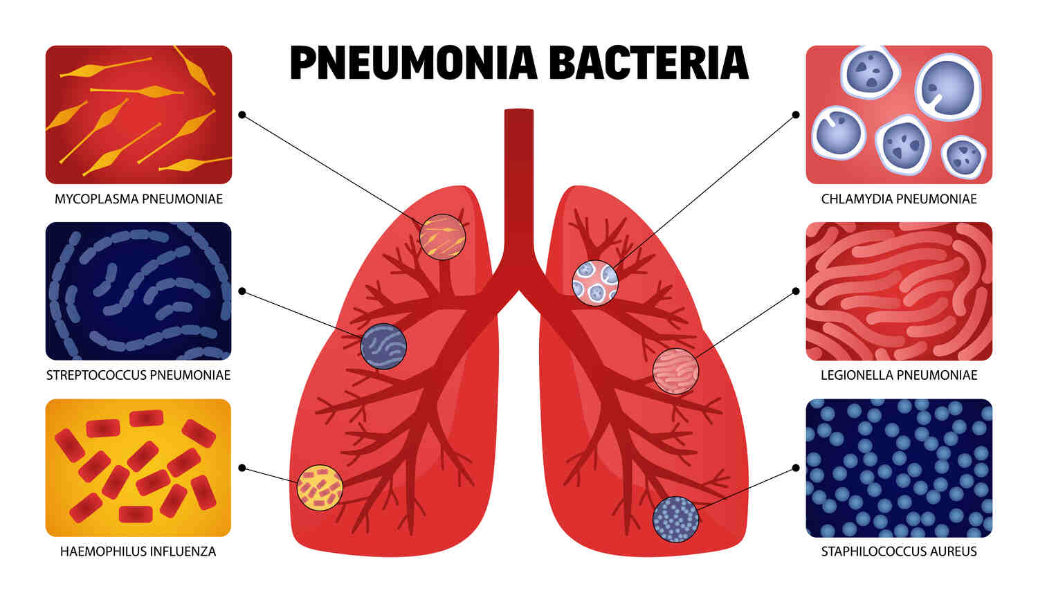 bacterial causes