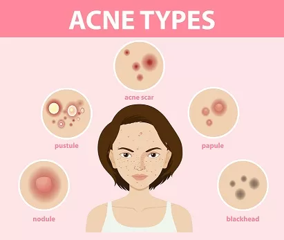 acne, acne vulgaris , types acne , 