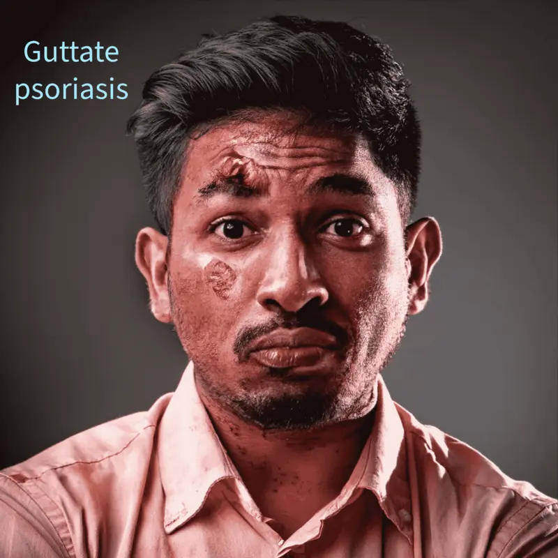 psoriasis, guttate psoriasis