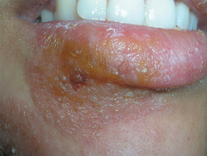 impetigo , streptococcus infection