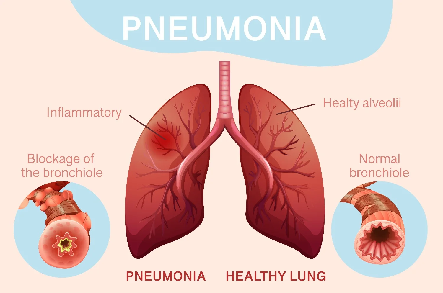 pneumonia 