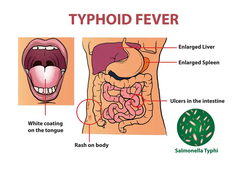 symptoms of typhoid fever, typhoid fever