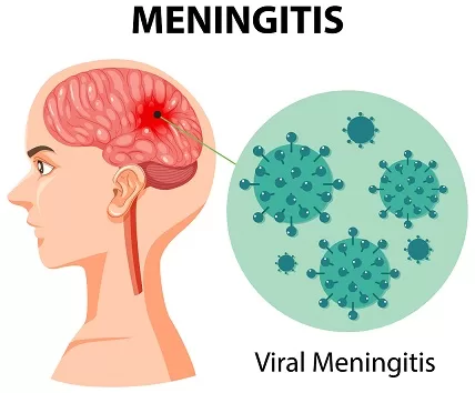 viral meningitis