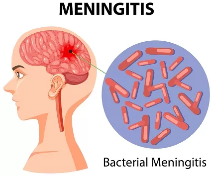 bacterial meningitis, bacterial meningitis precautions, bacterial meningitis isolation