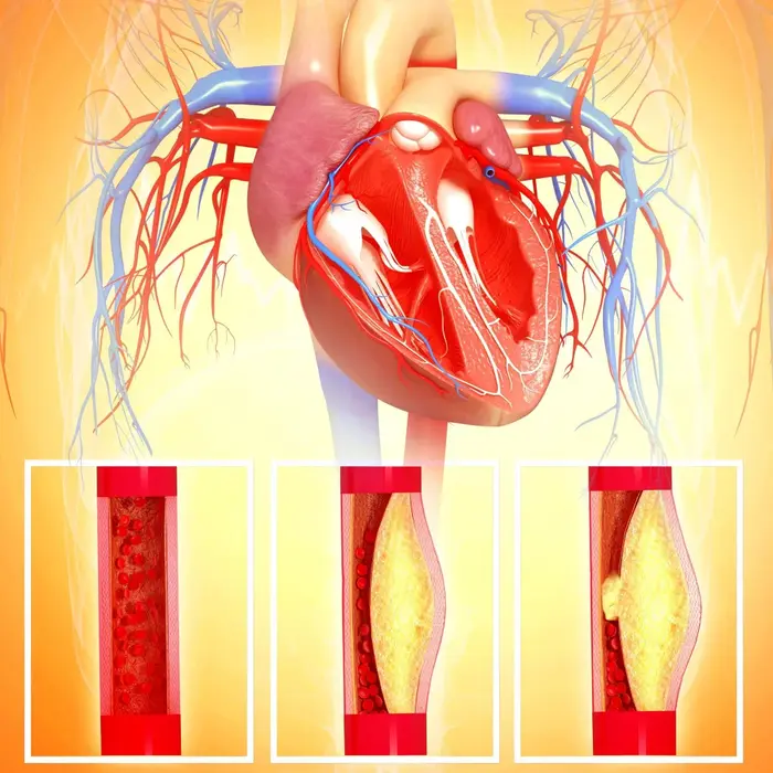 aortic aneurysm