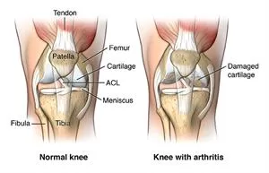 osteoarthritis , arthritis