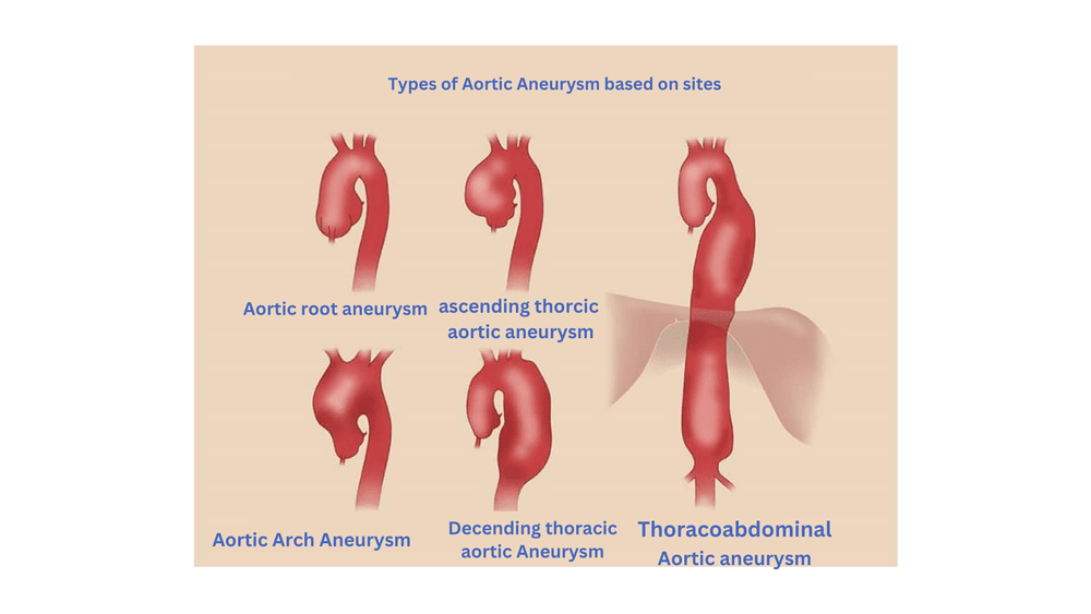 aortic aneurysm, types of aortic aneurysm