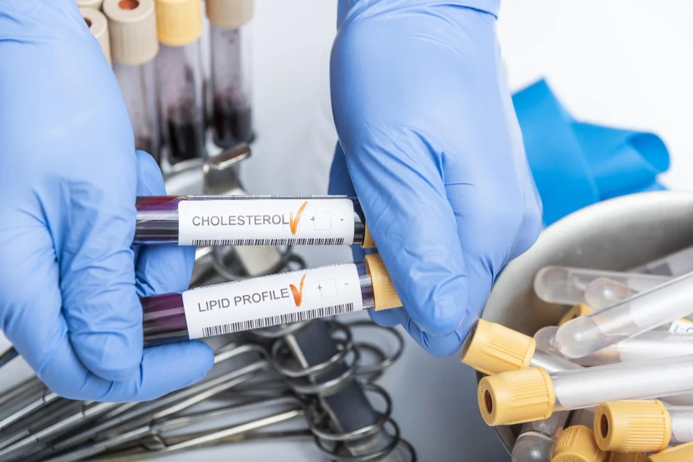 lipid profile, cholesterol , LDL, hyperlipidemia