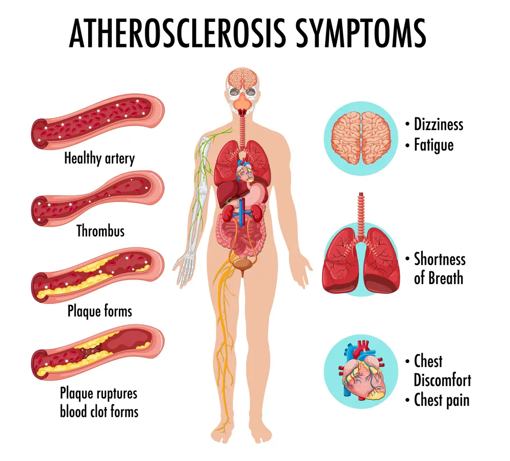 atherosclerosis, symptoms of atherosclerosis 