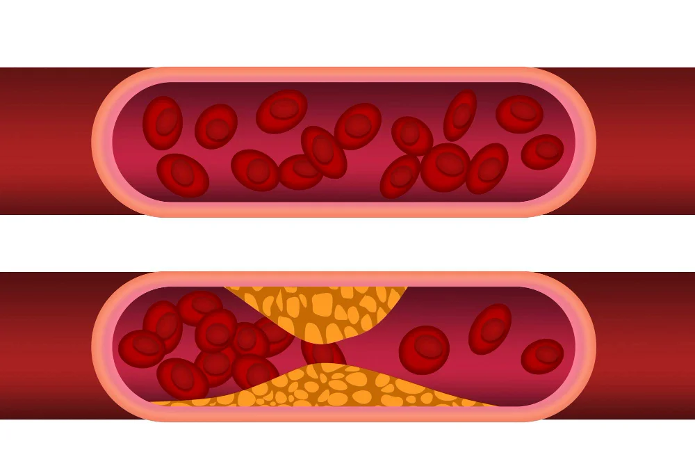 hyperlipidemia, cholesterol, triglyceridemia