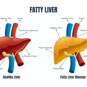 fatty liver disease