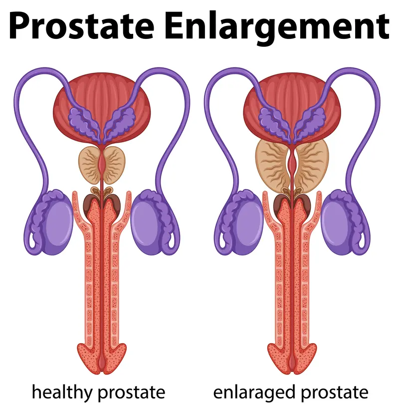 benign prostatic hypertrophy, BPH , urinary incontinence, urine retention