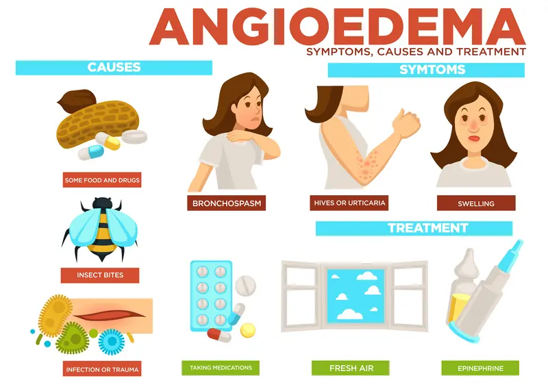 causes of angioedema, symptoms of angioedema, treatment of angioedema