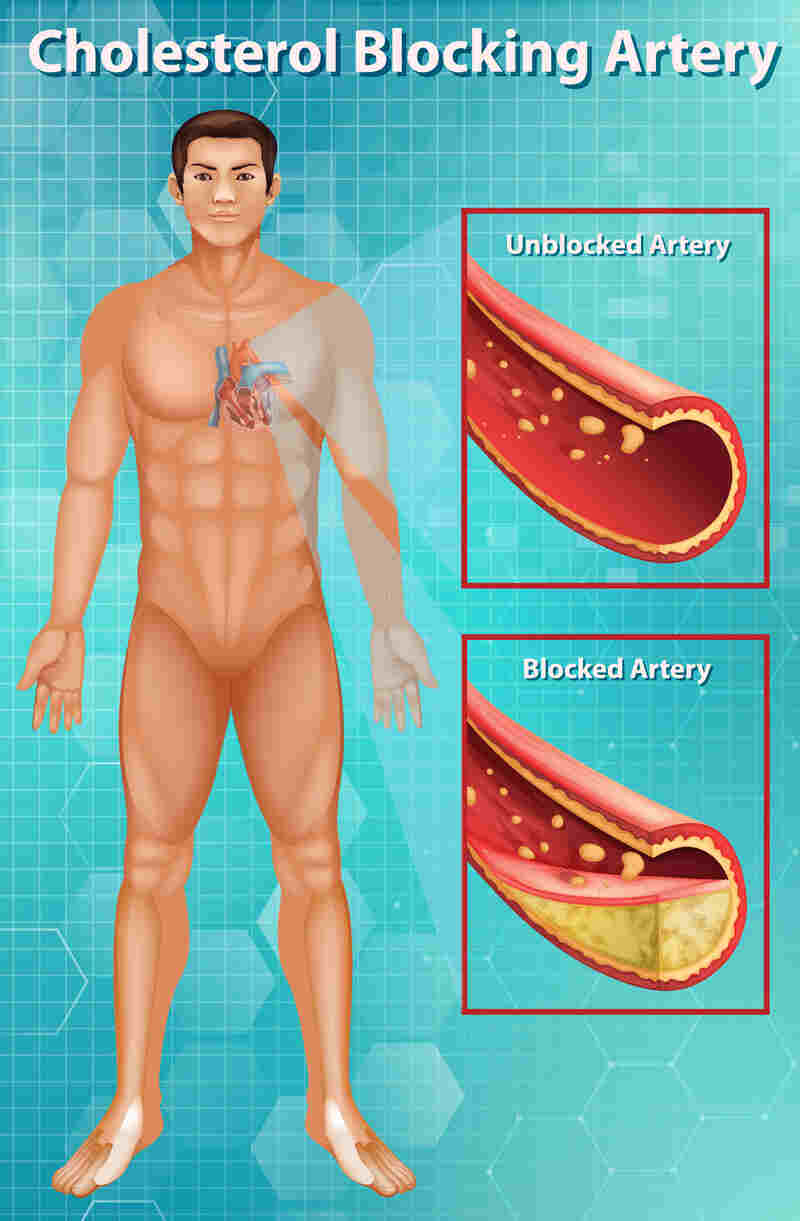 HYPERLIPIDEMIA, HYPERCHOLESTROLEMIA