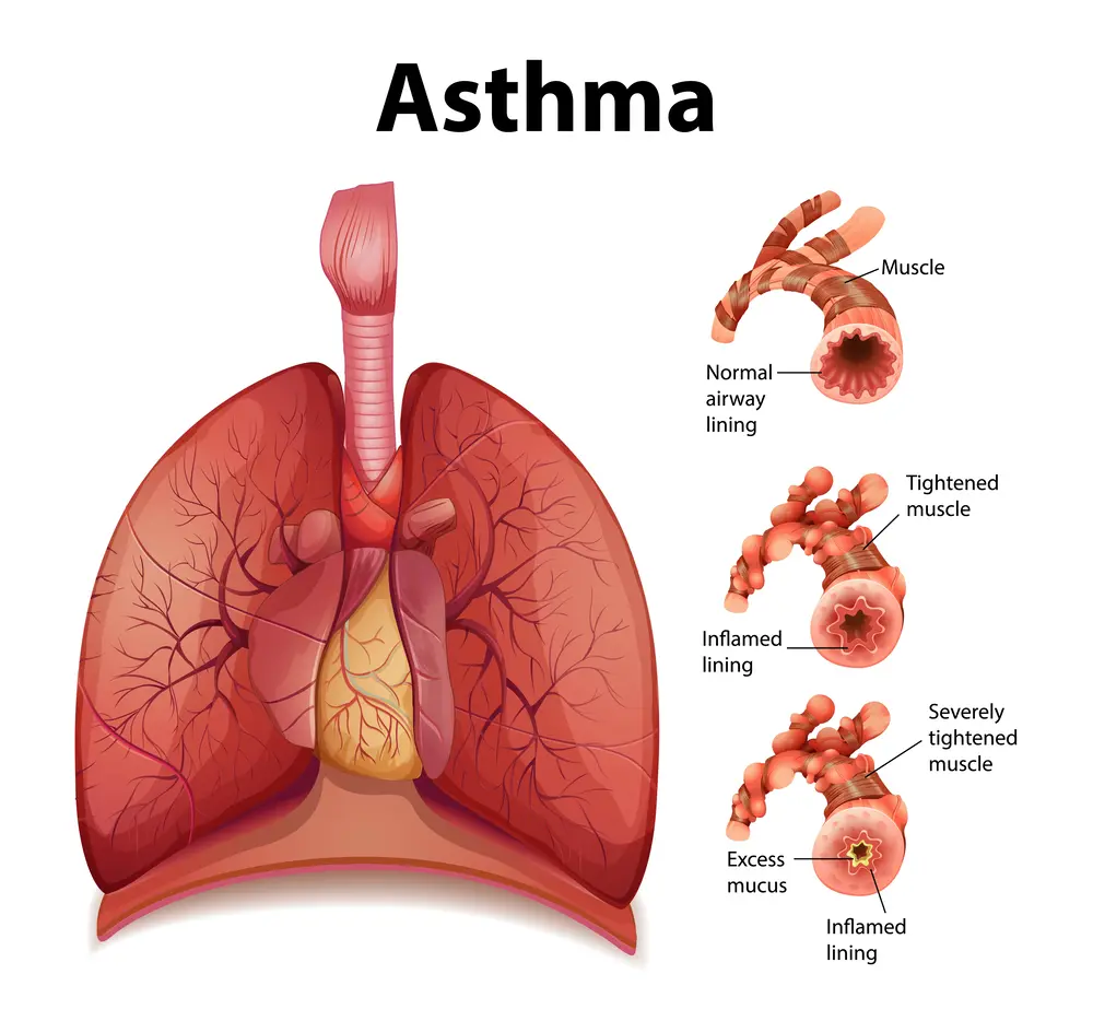 pathogenesis of asthma, asthma