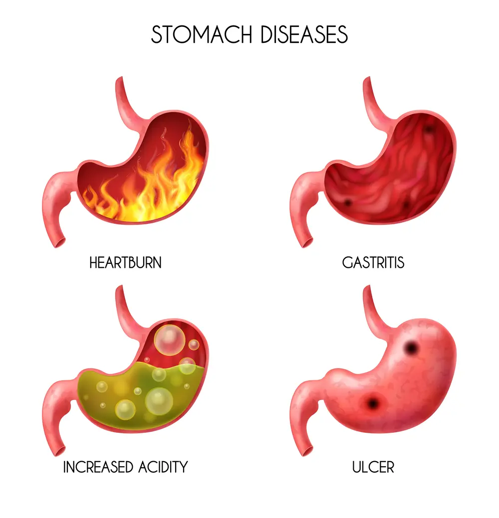 heartburn, gastritis, ulcer, acidity