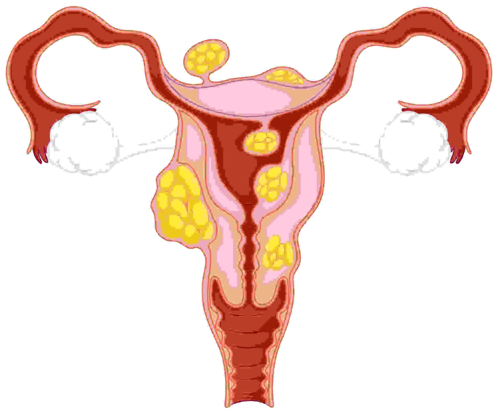 uterine fibroids