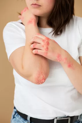 psoriasis, psoriasis treatment