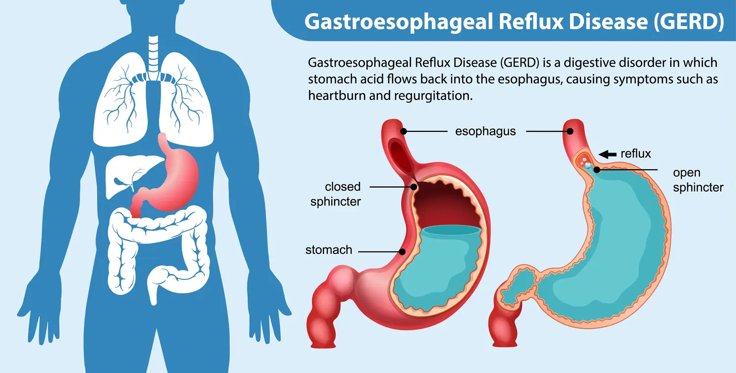 GERD, gastroesophageal reflux , gastritis