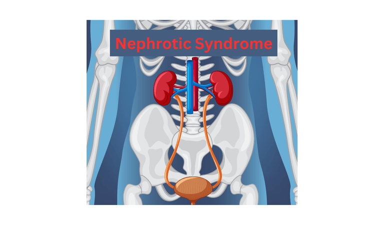 nephrotic syndrome, hyperalbuminemia, edema