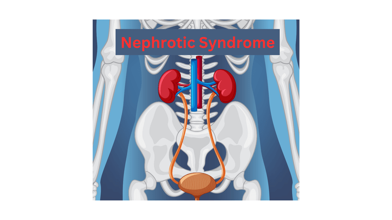 nephrotic syndrome, hyperalbuminemia, edema