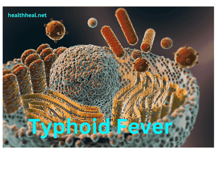 typhoid fever