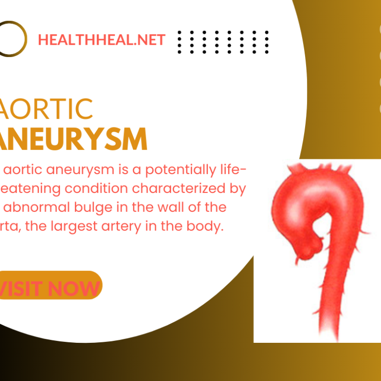 aortic aneurysm ,