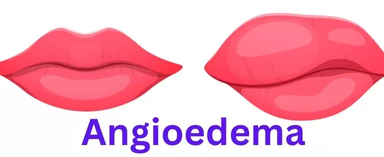 angioedema, angioedema lips photos, pictures of angioedema of the lips