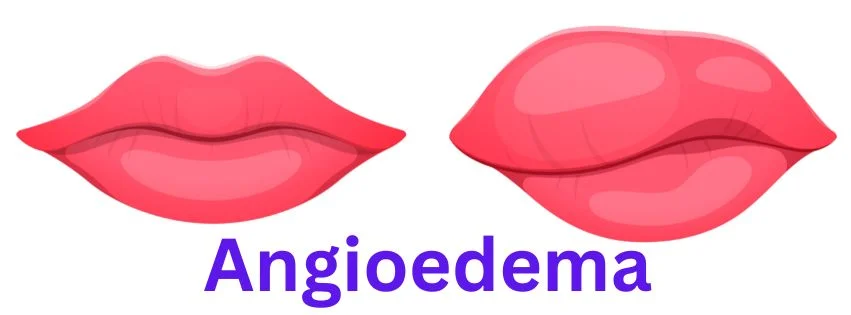 angioedema, angioedema lips photos, pictures of angioedema of the lips