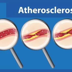 atherosclerosis,