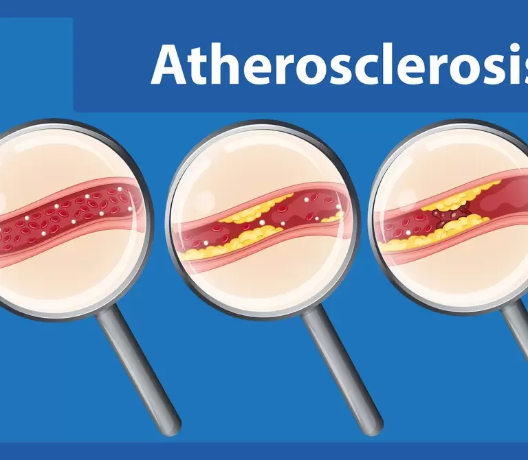 atherosclerosis,