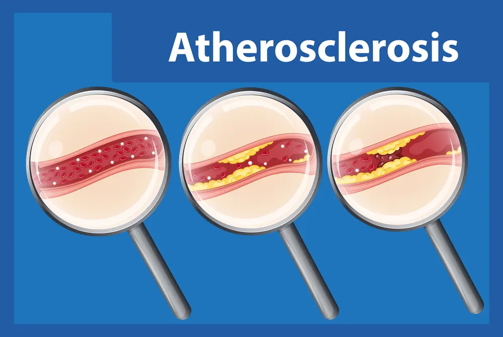 atherosclerosis,