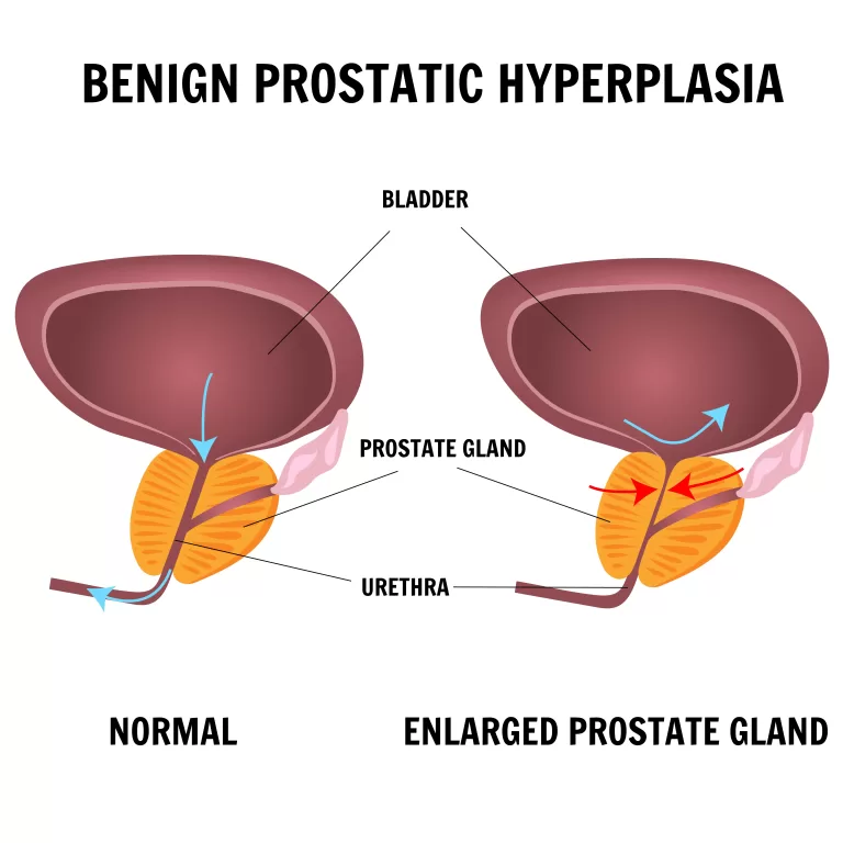 benign prostatic hypertrophy, BPH