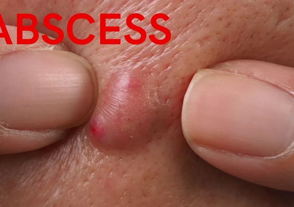 abscess , pus, incision and drainage