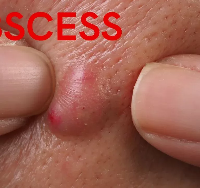 abscess , pus, incision and drainage