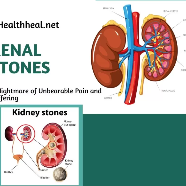 urinary calculi, kidney stones, ureter stones, bladder stones