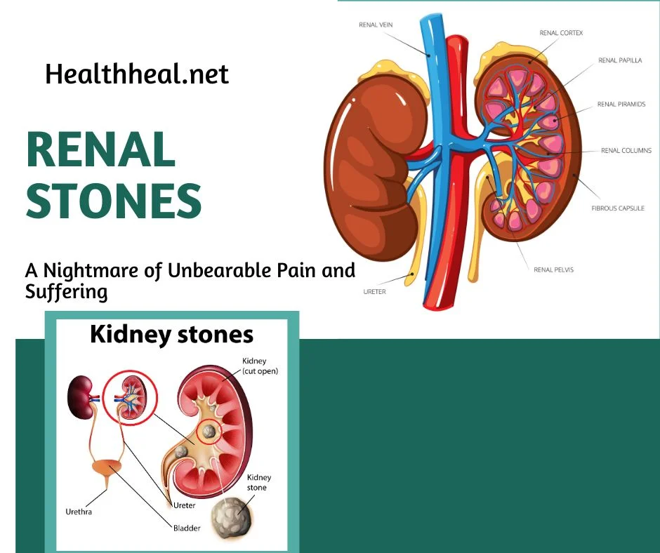 urinary calculi, kidney stones, ureter stones, bladder stones