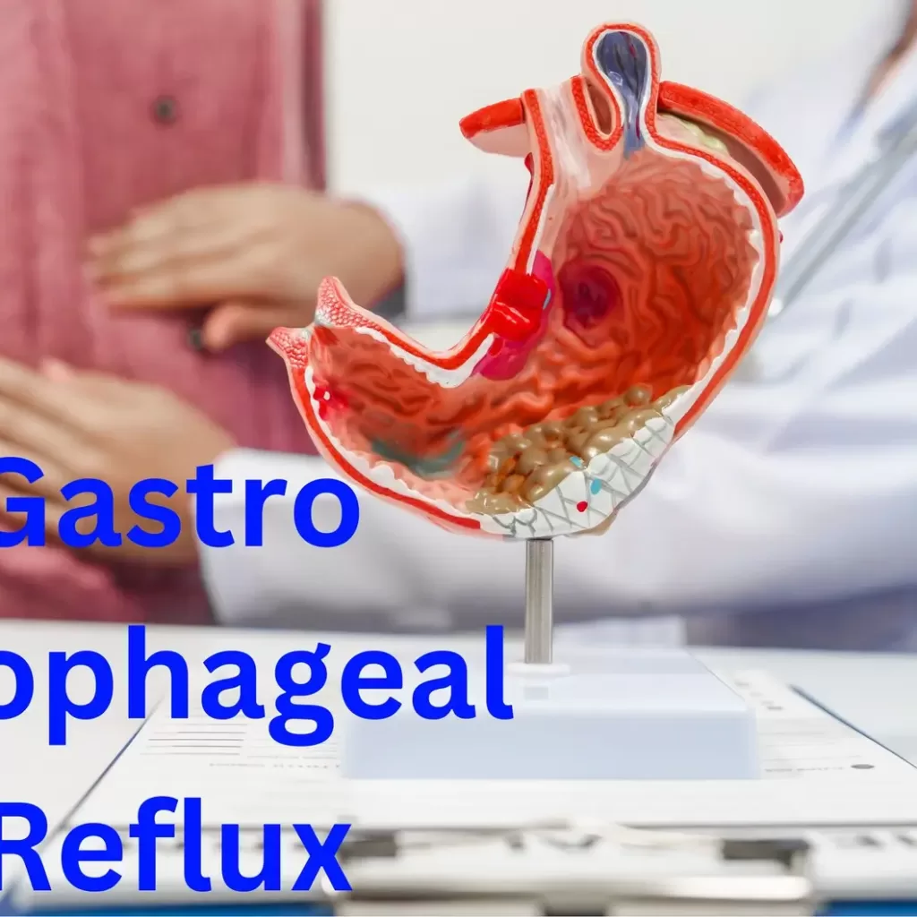 GERD, gastroesophageal reflux, gastritis, barrette esophagus