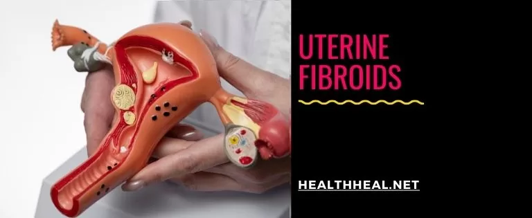 uterine fibroids