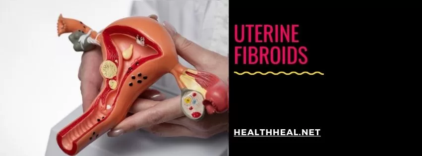 uterine fibroids