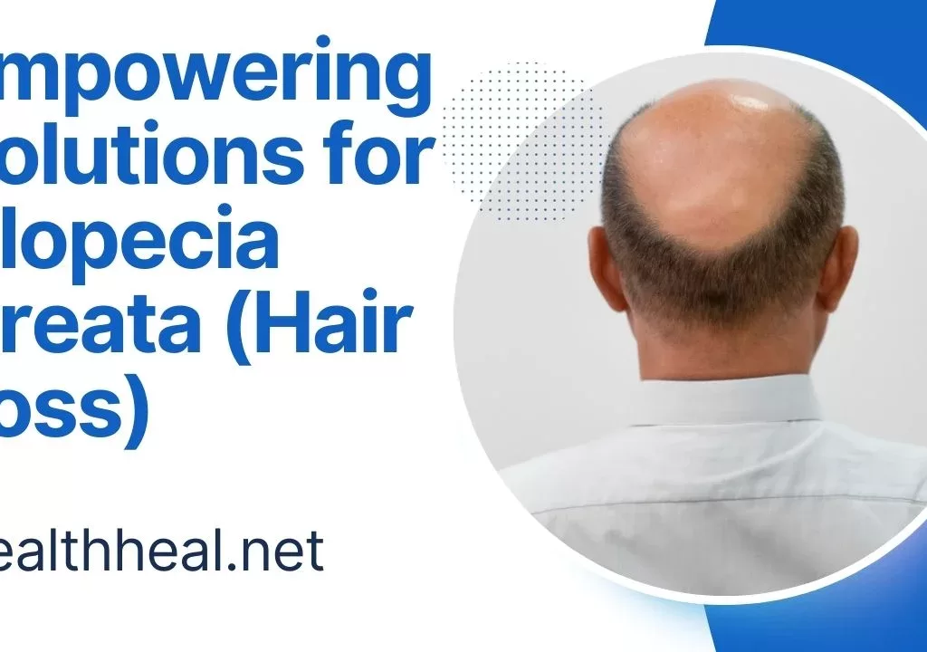 alopecia areata